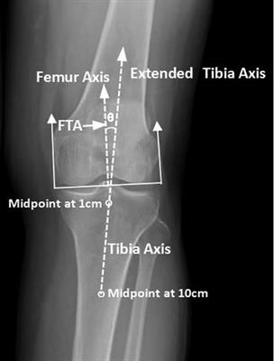 A Strong Correlation Between the Severity of Flatfoot and Symptoms of Knee Osteoarthritis in 95 Patients